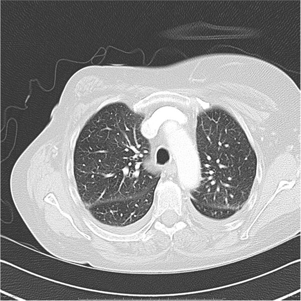 File:Acute-on-chronic pulmonary emboli (Radiopaedia 27925-28169 lung window 14).jpg