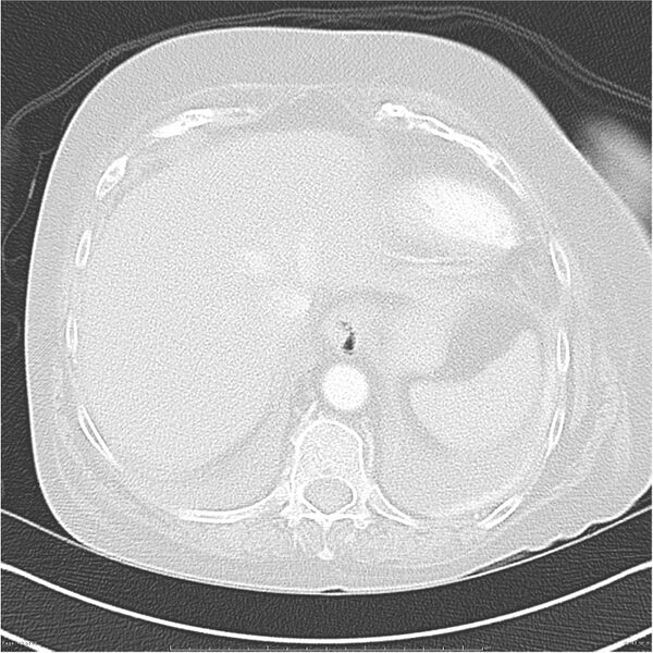 File:Acute-on-chronic pulmonary emboli (Radiopaedia 27925-28169 lung window 43).jpg