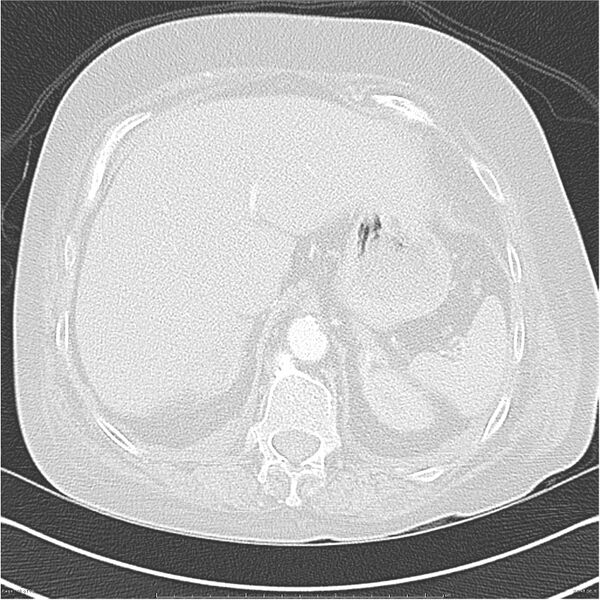 File:Acute-on-chronic pulmonary emboli (Radiopaedia 27925-28169 lung window 48).jpg