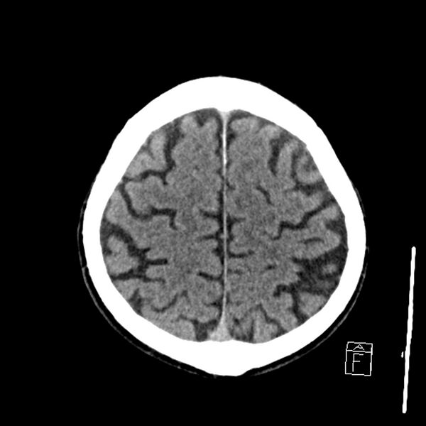File:Acute P1 occlusion with PCA ischemia penumbra (CT perfusion) (Radiopaedia 72084-82586 Axial non-contrast 37).jpg