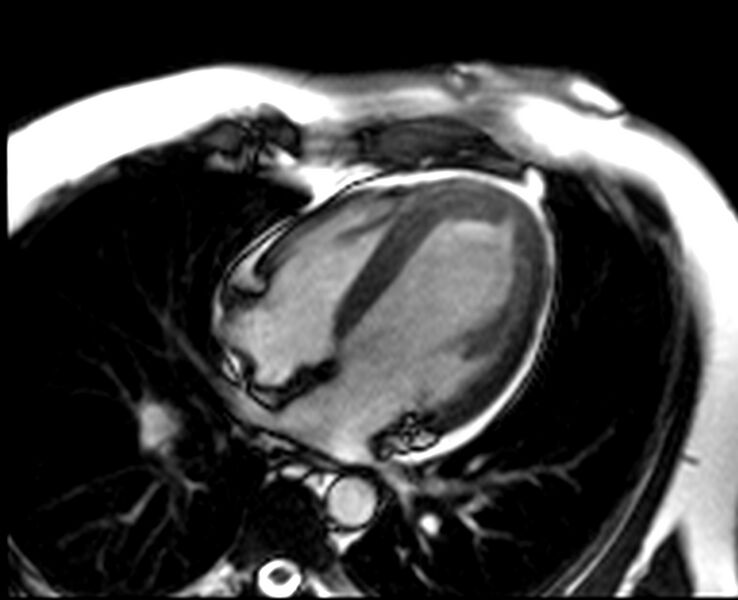 File:Acute anteroseptal myocardial infarction (Radiopaedia 68409-77944 Four chambers view SSFP cine 23).jpg