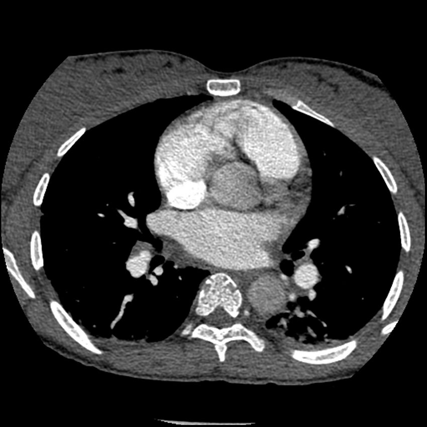 Acute chest syndrome - sickle cell disease (Radiopaedia 42375-45499 Axial C+ CTPA 96).jpg