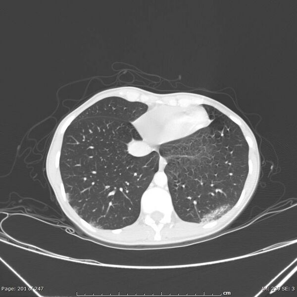File:Acute eosinophilic pneumonia (Radiopaedia 48211-53073 Axial 72).jpg