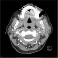 Acute left parotid sialadenitis (Radiopaedia 26160-26295 C+ arterial phase 16).jpg