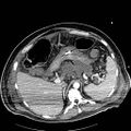 Acute pancreatic necrosis (Radiopaedia 13560-18502 Axial C+ portal venous phase 12).jpg