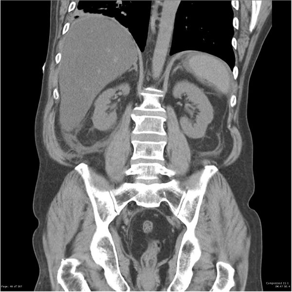 File:Acute pancreatitis (Radiopaedia 19135-19116 Coronal non-contrast 32).jpg