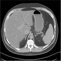 Acute pancreatitis - mild (Radiopaedia 27796-28033 Axial non-contrast 2).jpg