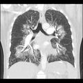 Acute pulmonary edema on CT (Radiopaedia 33582-34672 Coronal lung window 21).jpg