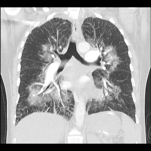 File:Acute pulmonary edema on CT (Radiopaedia 33582-34672 Coronal lung window 21).jpg