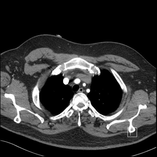 File:Acute pulmonary embolism with pulmonary infarct (Radiopaedia 73062-83768 Axial C+ CTPA 10).jpg