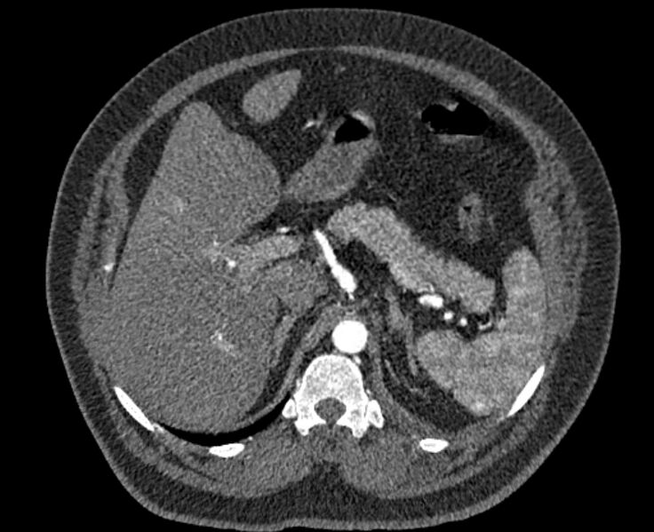 File:Acute pulmonary embolism with pulmonary infarcts (Radiopaedia 77688-89908 Axial C+ CTPA 76).jpg