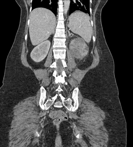 File:Acute pyelonephritis with renal vein thrombosis (Radiopaedia 58020-65053 Coronal renal parenchymal phase 91).jpg