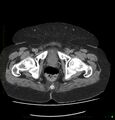 Acute renal failure post IV contrast injection- CT findings (Radiopaedia 47815-52557 Axial non-contrast 79).jpg