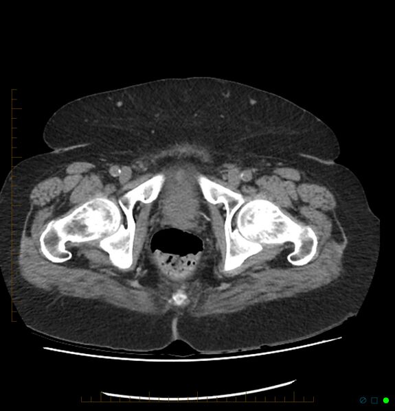 File:Acute renal failure post IV contrast injection- CT findings (Radiopaedia 47815-52557 Axial non-contrast 79).jpg