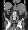 Acute renal failure post IV contrast injection- CT findings (Radiopaedia 47815-52557 Coronal non-contrast 28).jpg