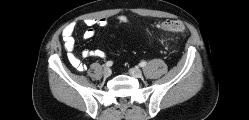 Acute sigmoid colon diverticulitis (Radiopaedia 55507-61976 Axial C+ portal venous phase 66).jpg