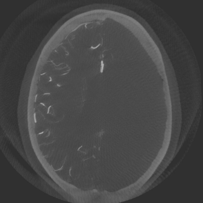 Acute subarachnoid hemorrhage and accessory anterior cerebral artery (Radiopaedia 69231-79010 Axial arterial - MIP 54).jpg