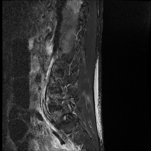 File:Acute vertebral body compression fractures (Radiopaedia 31757-32694 Sagittal STIR 14).jpg