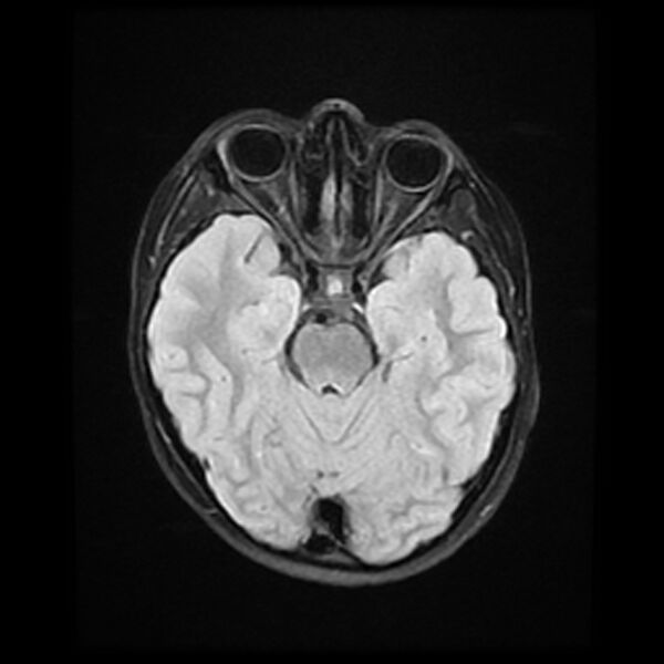 File:Adamantinomatous craniopharyngioma (Radiopaedia 77407-89529 Axial FLAIR 9).jpg