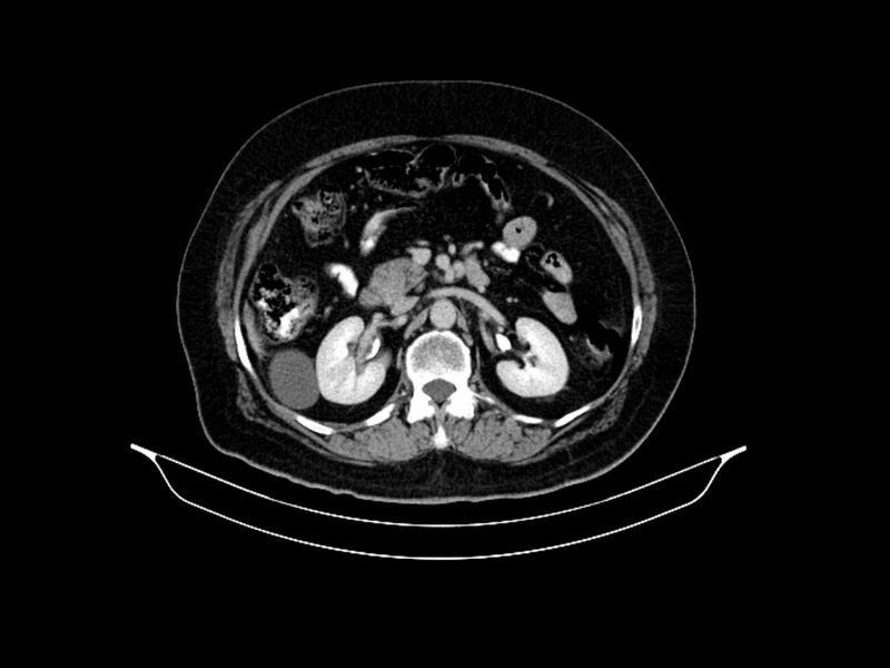 File:Adenocarcinoma of pancreas with hepatic metastasis (Radiopaedia 64332-73122 Axial C+ delayed 41).jpg