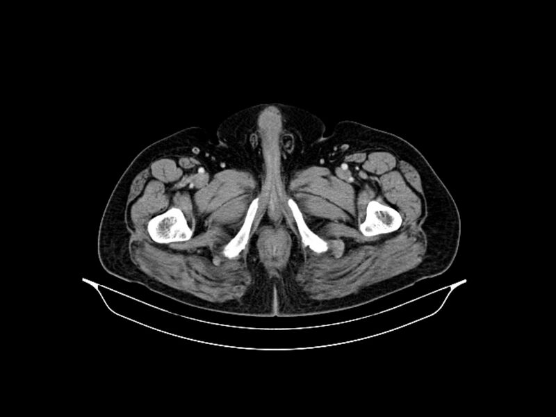 File:Adenocarcinoma of pancreas with hepatic metastasis (Radiopaedia 64332-73122 Axial C+ portal venous phase 107).jpg