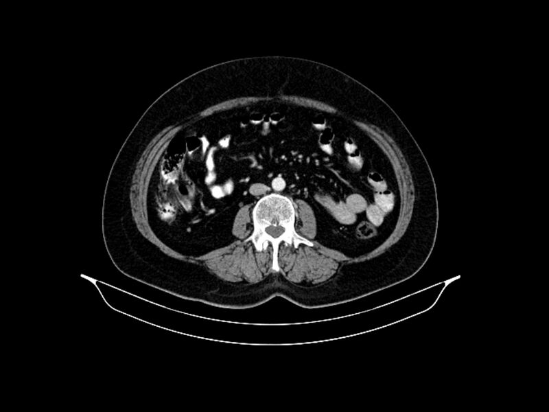 File:Adenocarcinoma of pancreas with hepatic metastasis (Radiopaedia 64332-73122 Axial C+ portal venous phase 56).jpg