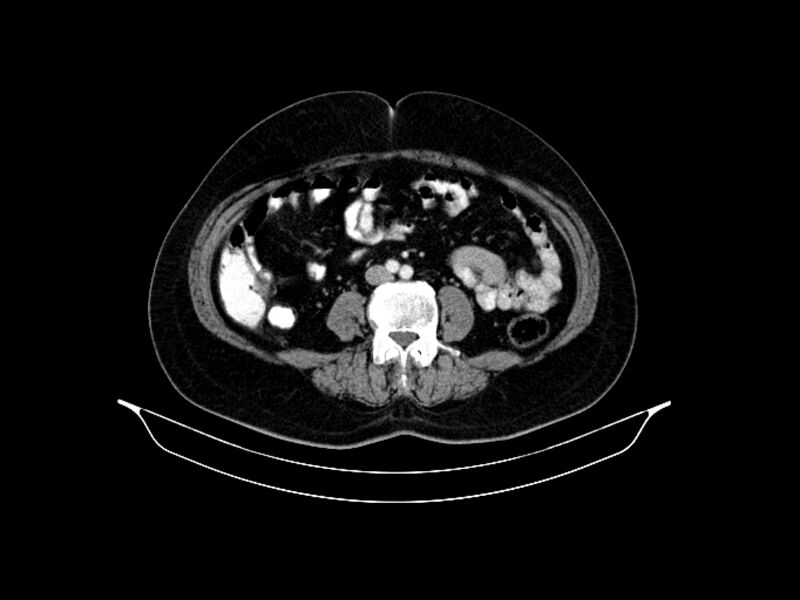 File:Adenocarcinoma of pancreas with hepatic metastasis (Radiopaedia 64332-73122 Axial C+ portal venous phase 62).jpg