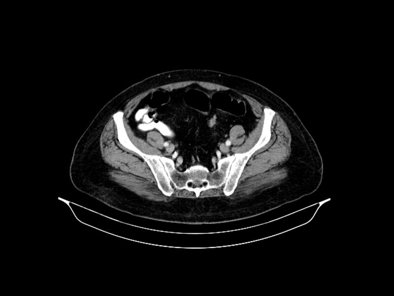 File:Adenocarcinoma of pancreas with hepatic metastasis (Radiopaedia 64332-73122 Axial C+ portal venous phase 81).jpg