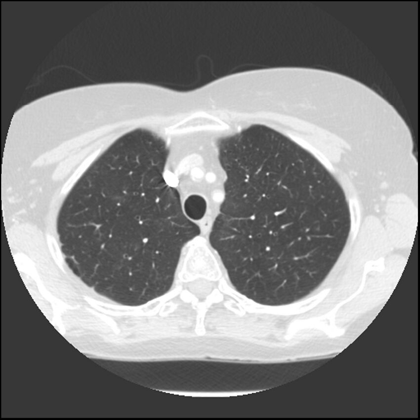 Adenocarcinoma of the lung (Radiopaedia 41015-43755 Axial lung window 27).jpg
