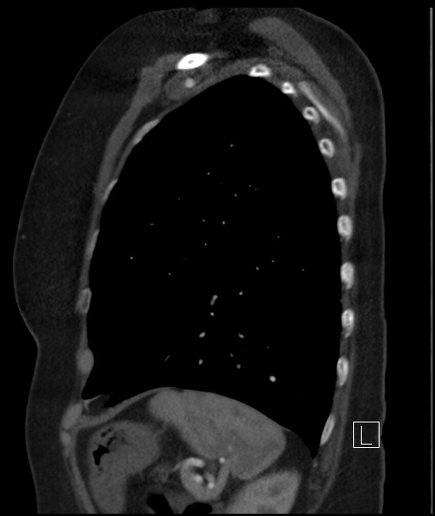 Adenocarcinoma of the lung (Radiopaedia 44205-47803 Sagittal C+ portal venous phase 13).jpg