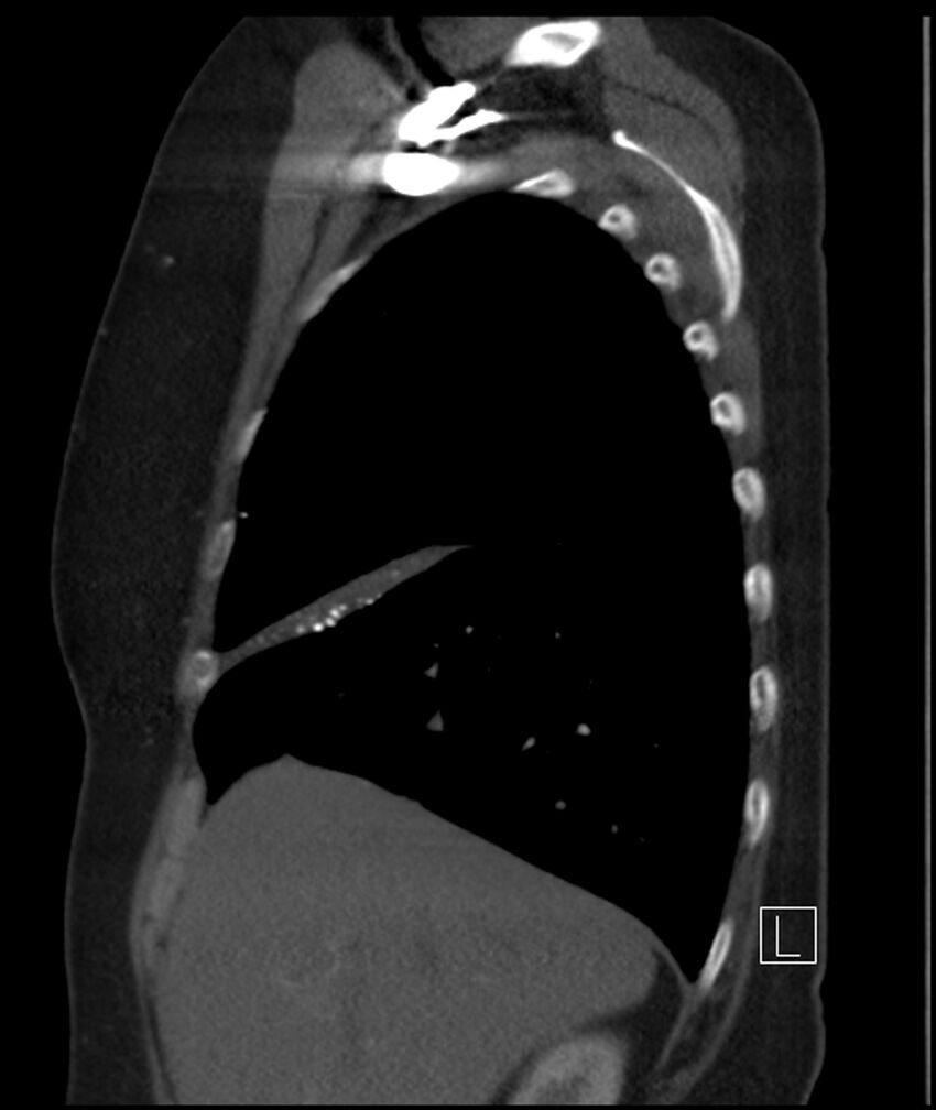 Adenocarcinoma of the lung (Radiopaedia 44205-47803 Sagittal C+ portal venous phase 43).jpg