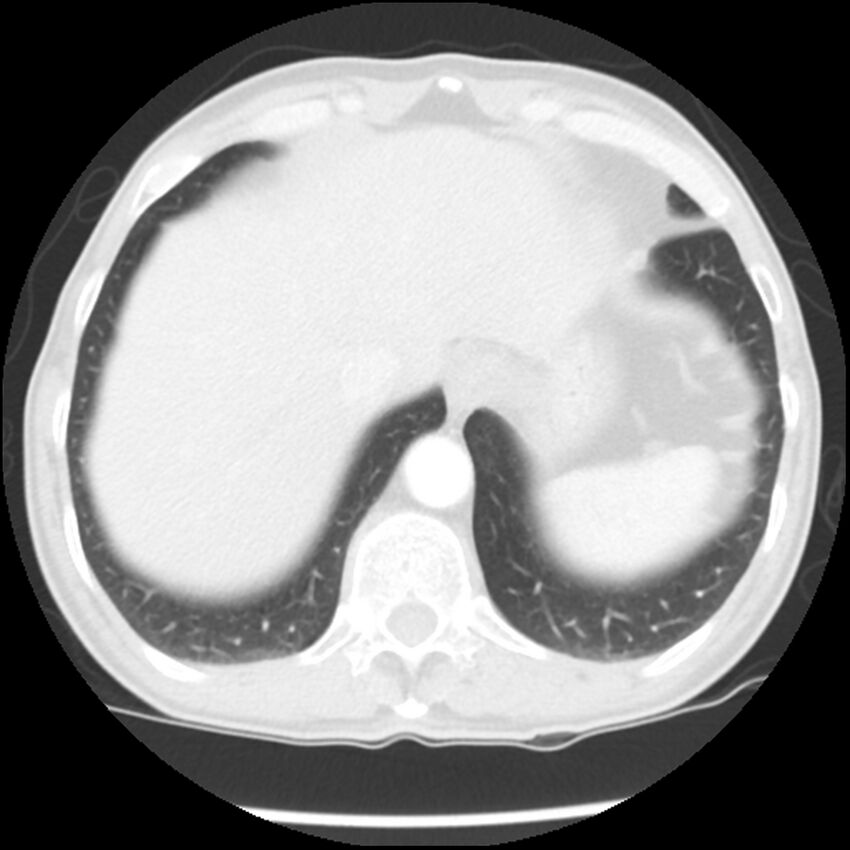 Adenocarcinoma of the lung - micropapillary predominant (Radiopaedia 42446-45563 Axial lung window 63).jpg