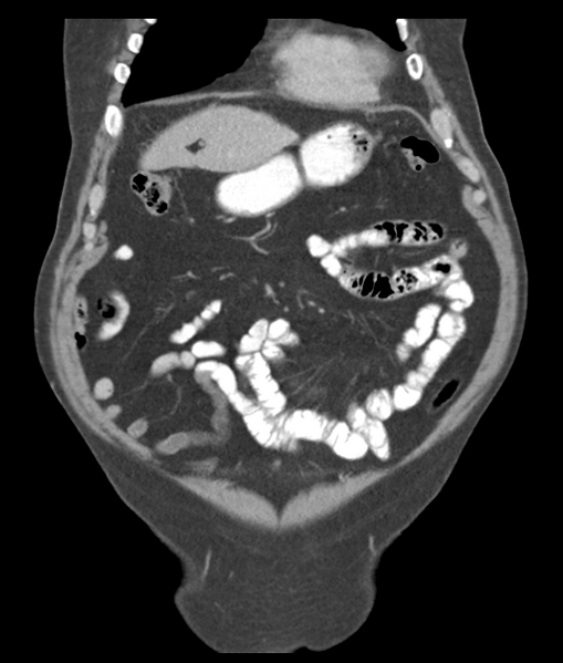 File:Adenocarcioma of rectum- T1 lesion (Radiopaedia 36921-38547 Coronal C+ portal venous phase 17).png