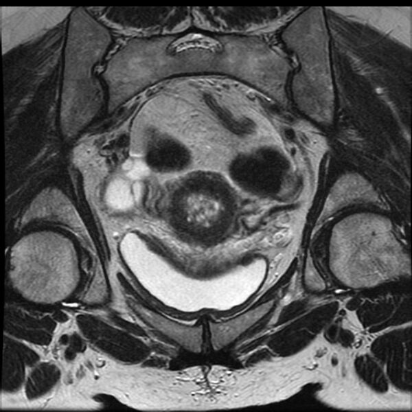 File:Adenoma malignum of the cervix (Radiopaedia 24460-24765 Coronal T2 14).jpg