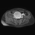 Adenomyoma of the uterus (huge) (Radiopaedia 9870-10438 Axial T1 C+ fat sat 22).jpg