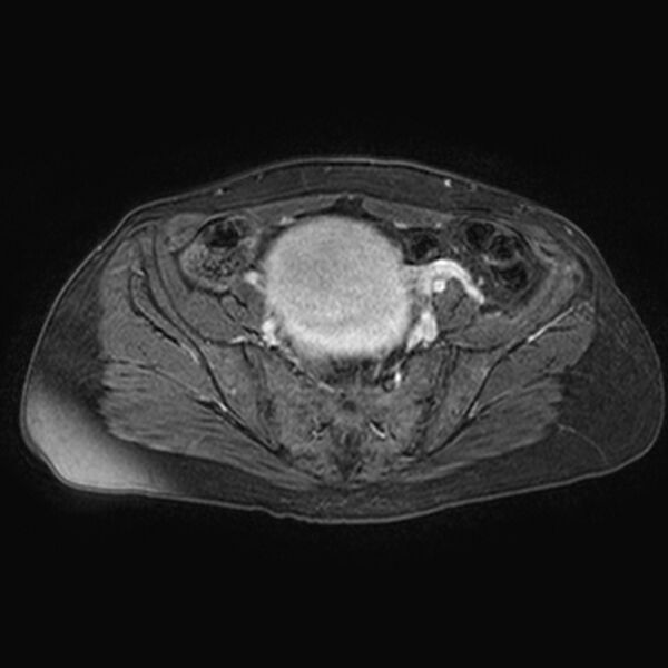 File:Adenomyoma of the uterus (huge) (Radiopaedia 9870-10438 Axial T1 C+ fat sat 22).jpg