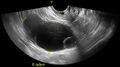 Adnexal multilocular cyst (O-RADS US 3- O-RADS MRI 3) (Radiopaedia 87426-103755 C 1).jpg