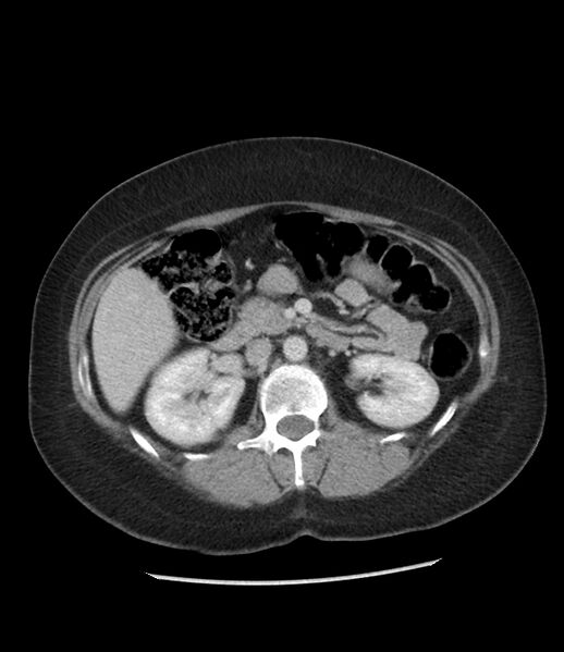 File:Adrenal cortical carcinoma with IVC invasion and thrombosis (Radiopaedia 34307-35597 Axial C+ portal venous phase 36).jpg