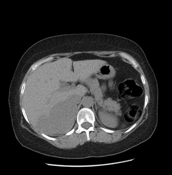 File:Adrenal cortical carcinoma with IVC invasion and thrombosis (Radiopaedia 34307-35597 Axial non-contrast 12).jpg