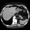 Adrenal hemangioma (Radiopaedia 11039-11445 Axial C+ arterial phase 1).jpg