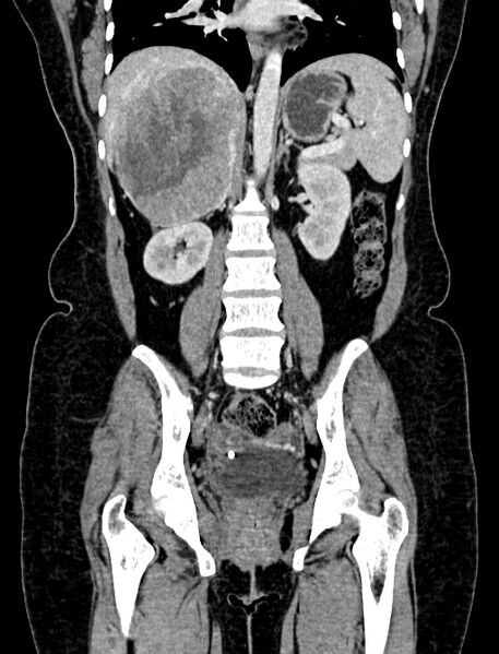 File:Adrenocortical carcinoma (Radiopaedia 87281-103569 Coronal C+ portal venous phase 72).jpg