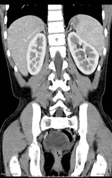 File:Agenesis of the gallbladder (Radiopaedia 55454-61905 A 35).jpg