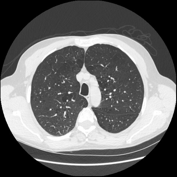 File:Alpha-1-antitrypsin deficiency (Radiopaedia 40993-43722 Axial lung window 60).jpg