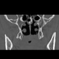 Ameloblastic fibro-odontoma (Radiopaedia 18843-18780 B 21).jpg
