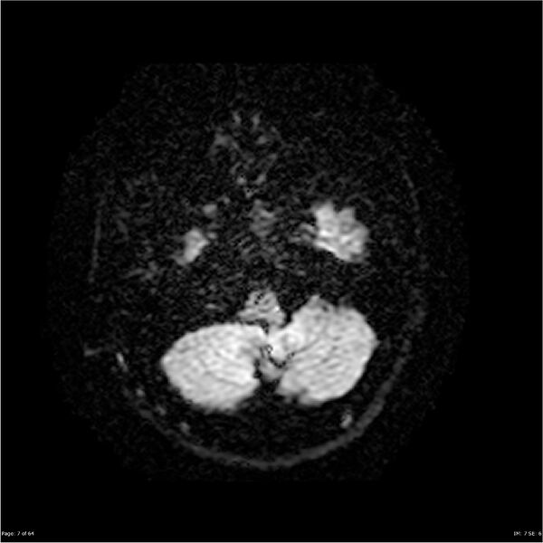 File:Amnestic syndrome secondary to hypoxic brain injury (Radiopaedia 24743-25004 DWI 7).jpg