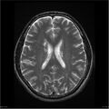 Amnestic syndrome secondary to hypoxic brain injury (Radiopaedia 24743-25004 T2 13).jpg