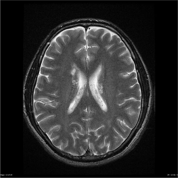 File:Amnestic syndrome secondary to hypoxic brain injury (Radiopaedia 24743-25004 T2 13).jpg
