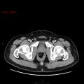 Ampullary carcinoma (Radiopaedia 56396-63056 C 101).jpg