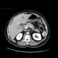 Ampullary carcinoma (Radiopaedia 56396-63056 C 32).jpg