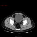 Ampullary carcinoma (Radiopaedia 56396-63056 C 90).jpg